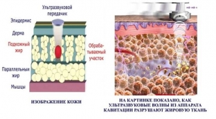 bezoperatsionnaya-liposaktsiya-plyusy-i-minusy-ultrazvukovoj-kavitatsii