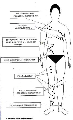 girudoterapiya-preimushchestva-i-nedostatki-lecheniya-piyavkami