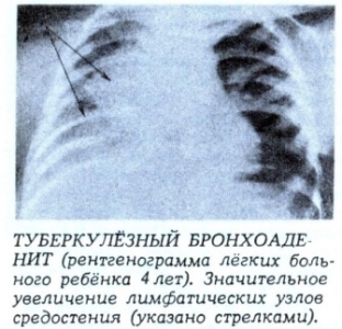 kak-ne-propustit-tuberkuleznyj-bronkhoadenit