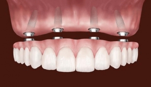 mikroprotezirovanie-zubov-estetichnost-funktsionalnost-dolgovechnost