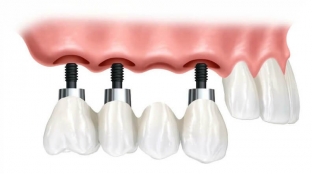 odnomomentnaya-implantatsiya-zubov-osobennosti-i-preimushchestva-protsedury
