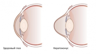pochemu-razvivaetsya-distrofiya-rogovitsy-mekhanizm-formirovaniya-keratokonusa