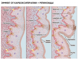 sochetanie-karboksiterapii-s-invazivnymi-metodikami-agressivnymi-pilingami-i-retinoidami