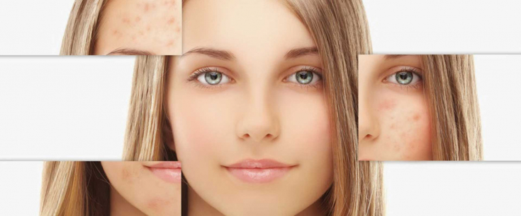 Системные препараты для лечения акне - Estet-Portal