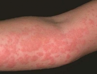 allergiya-na-khurmu-vitaminoterapiya-trebuet-osmotritelnosti