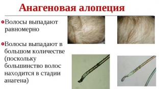 anagenovaya-alopetsiya-prichiny-i-lechenie