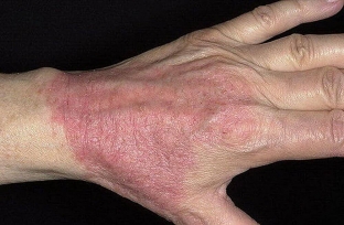 atopicheskij-dermatit-u-vzroslykh-prichiny-simptomy-i-lechenie