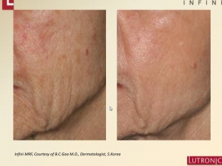 bystro-effektivno-podtyanuto-omolazhivayushchie-protsedury-s-rf-apparatom-infini