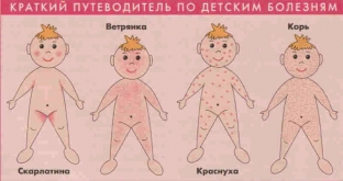 chem-otlichaetsya-syp-pri-raznykh-detskikh-infektsionnykh-boleznyakh