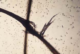 diagnostika-i-effektivnye-metody-lecheniya-trikhoklazii-volos