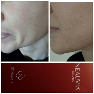 effektivnaya-protsedura-dlya-vyrazhennogo-liftinga-ovala-litsa