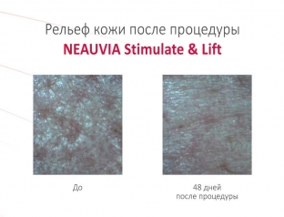 effektivnaya-protsedura-dlya-vyrazhennogo-liftinga-ovala-litsa