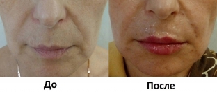 effektivnoe-omolozhenie-posle-50-let-kombinatsiya-anti-age-protsedur