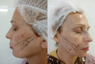 effektivnoe-omolozhenie-posle-50-let-kombinatsiya-anti-age-protsedur