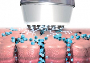 elektroporatsiya-gub-effekt-pukhlykh-gub-bez-ukolov