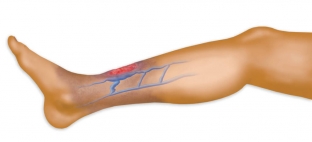 kak-opredelit-prichinu-troficheskoj-yazvy