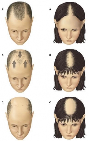 kak-ostanovit-vypadenie-i-vosstanovit-rost-volos-metody-lecheniya-alopetsii