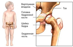 kakie-ortopedicheskie-problemy-chasto-vstrechayutsya-u-mladentsev