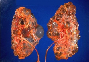 klinicheskie-proyavleniya-i-oslozhneniya-polikistoza-pochek