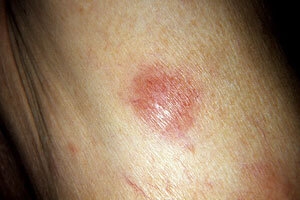 klinicheskij-sluchaj-slozhnoj-diagnostiki-t-kletochnoj-limfomy-kozhi-chast-1