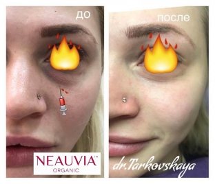 korrektsiya-periorbitalnoj-zony-litsa-fillerami-kak-vybrat-effektivnyj-preparat