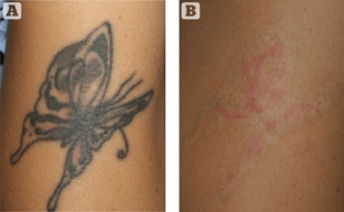 lazery-dlya-udaleniya-tatuirovok-s-modulyatsiej-dobrotnosti-kombinirovanie-tekhnologij