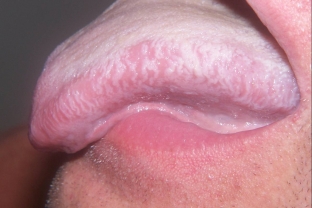 lejkoplakiya-polosti-rta-mozhet-preduprezhdat-o-predrakovom-sostoyanii