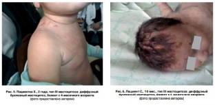 mastotsitoz-trudnosti-diagnostiki-i-osobennosti-lecheniya