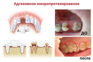 mikroprotezirovanie-zubov-estetichnost-funktsionalnost-dolgovechnost
