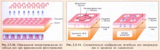 neablyatsionnoe-lazernoe-omolozhenie-kozhi-fraktsionnyj-fototermoliz