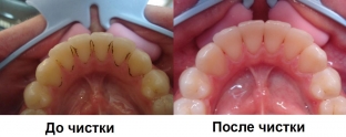 novye-apparaty-dlya-chistki-zubov-preimushchestva-ultrazvukovoj-chistki-zubov