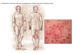 novye-vozmozhnosti-lecheniya-atopicheskogo-dermatita-u-detej-i-vzroslykh