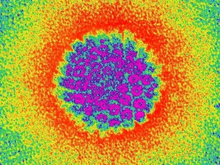 novyj-podkhod-v-lechenii-papillomavirusnoj-infektsii