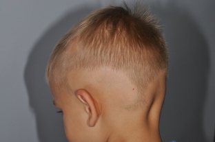 ochagovaya-alopetsiya-proverennye-metodiki-i-vozmozhnye-oshibki-v-lechenii