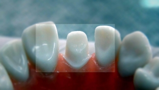 osnovnye-aspekty-i-tseli-preparirovaniya-zubov
