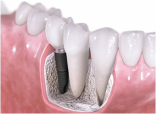 osobennosti-lecheniya-gangrenoznogo-pulpita-i-implantatsiya-zubov