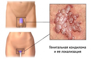 papillomavirusnaya-infektsiya-opasny-li-borodavki-i-kondilomy