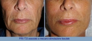 pilingi-s-trikhloruksusnoj-kislotoj-kogda-reabilitatsiya-kozhe-ne-nuzhna