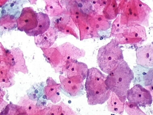 prichiny-i-metody-lecheniya-bakterialnogo-vaginoza