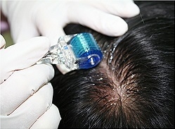 primenenie-dermarollera-v-lechenii-alopetsii