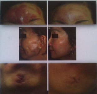 primenenie-rf-volny-konchike-igly-i-kanyuli