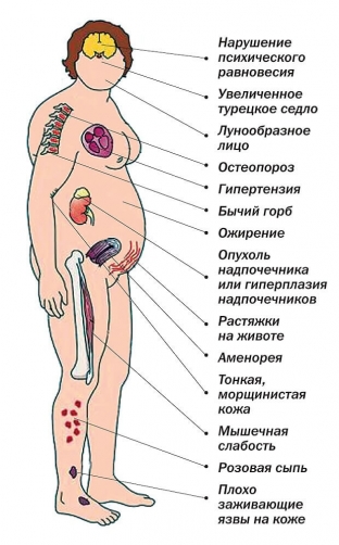 rak-nadpochechnikov-mozhet-maskirovatsya-pod-sindrom-itsenko-kushinga