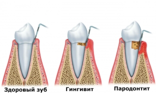 shag-vpravo-shag-vlevo-kak-lechit-parodontit