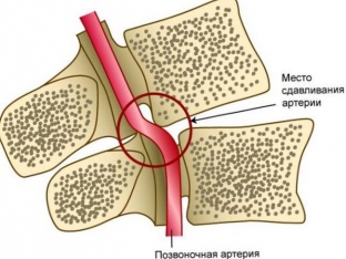 sindrom-pozvonochnoj-arterii-na-fone-razvitiya-shejnogo-osteokhondroza