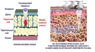 ultrazvukovaya-kavitatsiya-bezoperatsionnaya-liposaktsiya