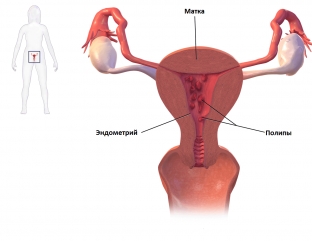 vnutrimatochnaya-patologiya-giperplasticheskie-protsessy-endometriya