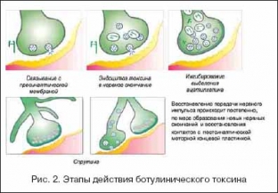 vozmozhnosti-i-perspektivy-ispolzovaniya-botulotoksina-v-klinicheskoj-praktike